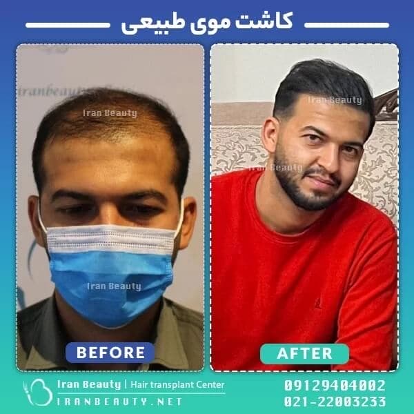 قبل و بعد از کاشت مو به روش SUPER FUE قبل و بعد از کاشت مو به روش SUPER FUE