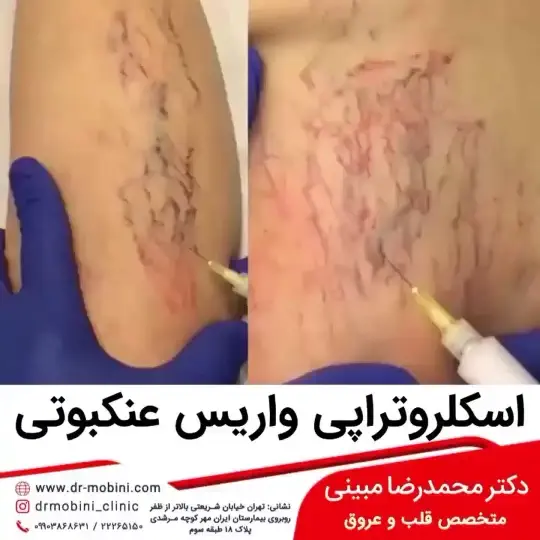 اسکلروتراپی واریس پا اسکلروتراپی واریس پا