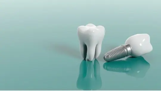 مشکلات ایمپلنت دندان مشکلات ایمپلنت دندان