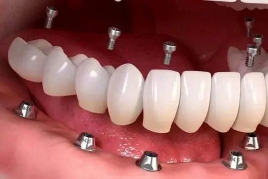 طراحی لبخند طراحی لبخند
