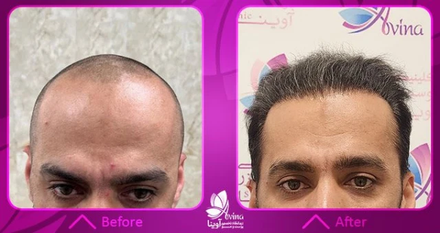 نمونه کار کاشت مو در کلینیک آوینا نمونه کار کاشت مو در کلینیک آوینا