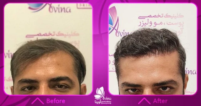 نمونه کار کاشت مو در کلینیک آوینا نمونه کار کاشت مو در کلینیک آوینا