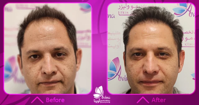 نمونه کار کاشت مو در کلینیک آوینا نمونه کار کاشت مو در کلینیک آوینا