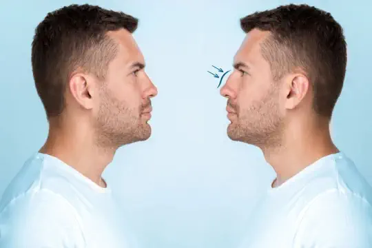 جراحی بینی زیبایی جراحی بینی زیبایی