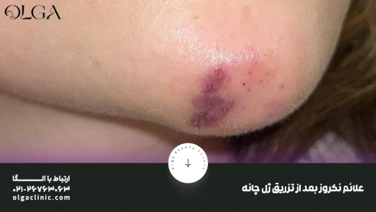 علائم نکروز ژل چانه علائم نکروز ژل چانه
