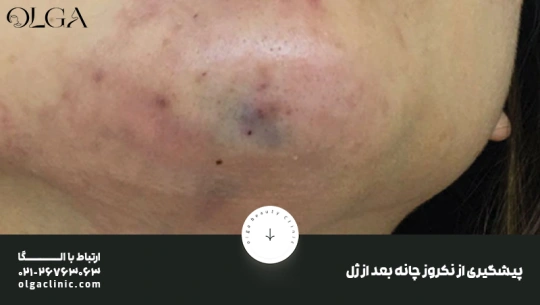 پیشگیری از نکروز چانه بعد از فیلر پیشگیری از نکروز چانه بعد از فیلر