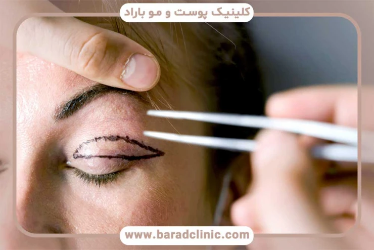 بلفاروپلاستی بلفاروپلاستی