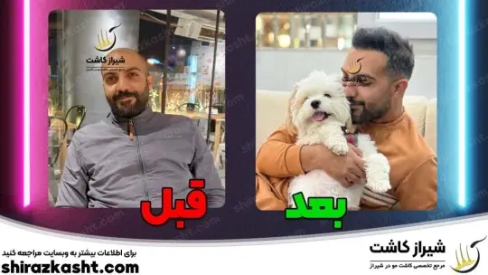 کاشت مو شیراز کاشت مو شیراز