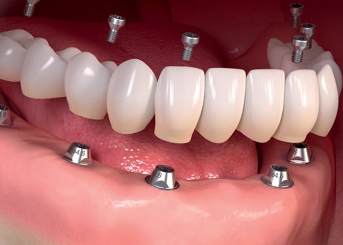 قیمت اوردنچر دندان قیمت اوردنچر دندان