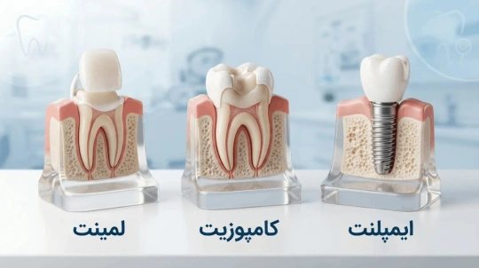 فرق لمینت، کامپوزیت و ایمپلنت چیست 