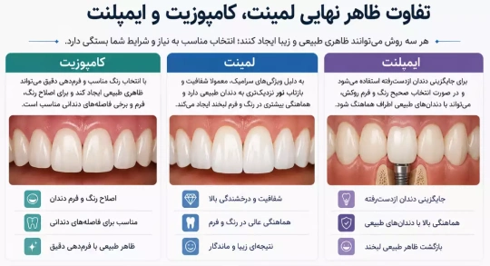 فرق ظاهر نهایی لمینت، کامپوزیت و ایمپلنت