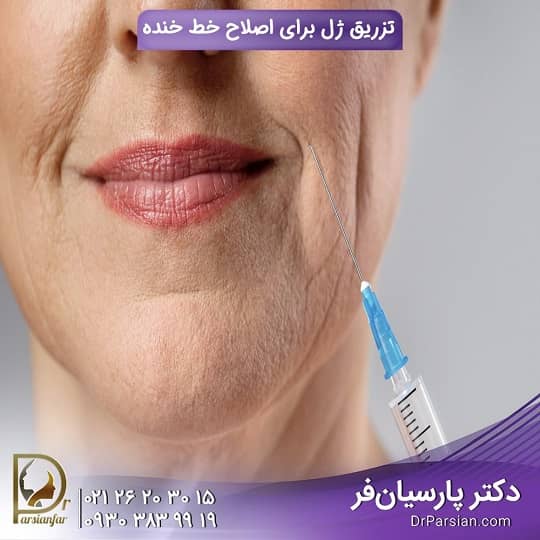 تزریق ژل دکتر پارسیان فر تزریق ژل دکتر پارسیان فر