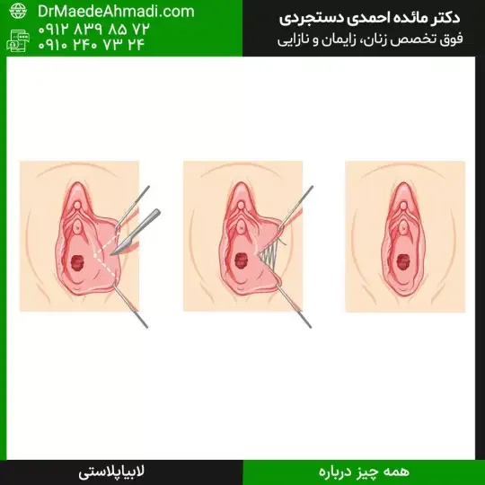 لابیاپلاستی توسط دکتر مائده احمدی دستجردی لابیاپلاستی توسط دکتر مائده احمدی دستجردی