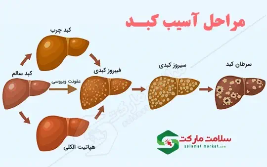 علائم و درمان کبد چرب چیست علائم و درمان کبد چرب چیست