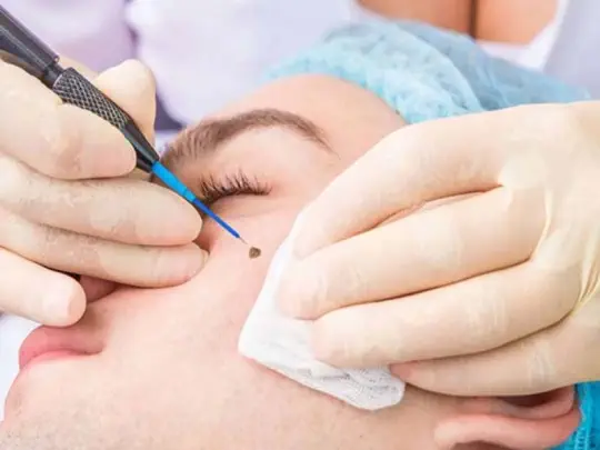 پزشک متخصص برداشتن خال پزشک متخصص برداشتن خال